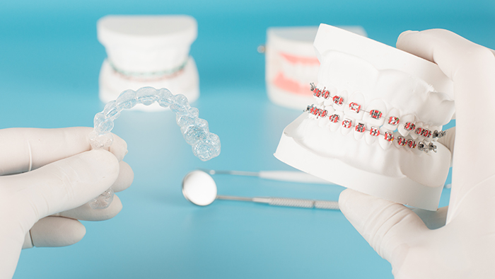 Invisalign or metal braces Ann Arbor MI Invisalign dentists